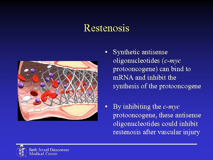 Restenosis • Synthetic antisense oligonucleotides (c-myc protooncogene) can bind to m. RNA and inhibit