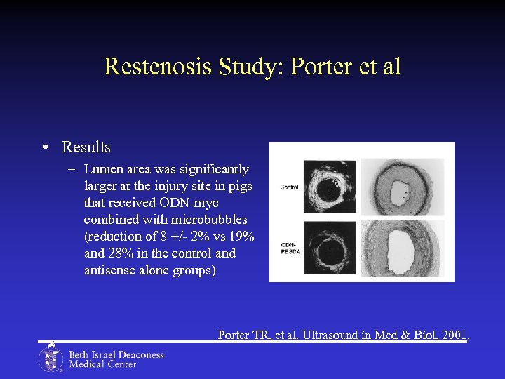 Restenosis Study: Porter et al • Results – Lumen area was significantly larger at