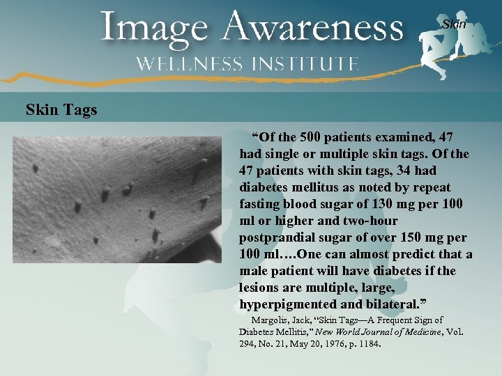 Skin Tags “Of the 500 patients examined, 47 had single or multiple skin tags.