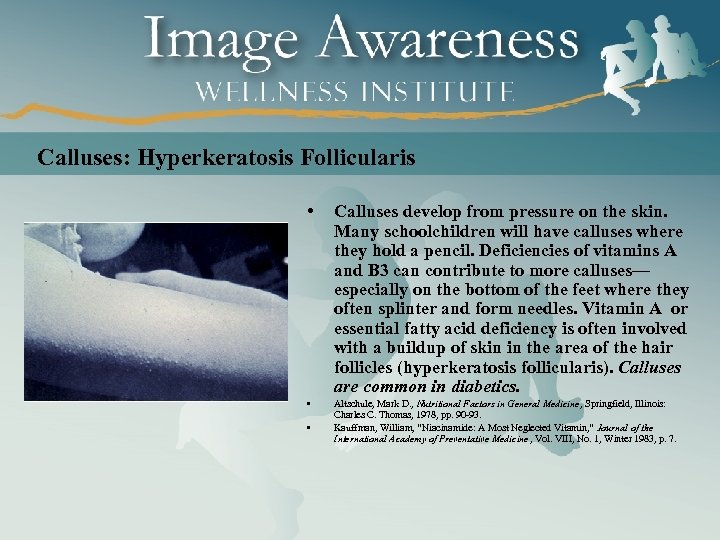 Calluses: Hyperkeratosis Follicularis • Calluses develop from pressure on the skin. Many schoolchildren will