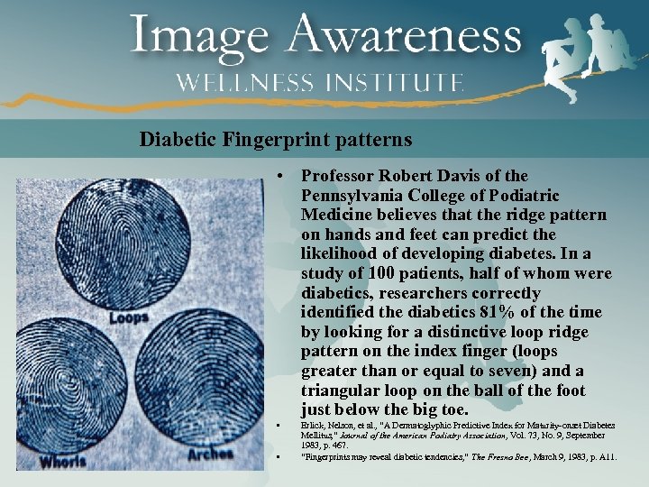 Diabetic Fingerprint patterns • Professor Robert Davis of the Pennsylvania College of Podiatric Medicine