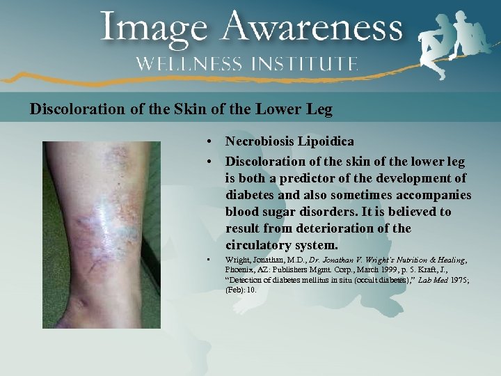 Discoloration of the Skin of the Lower Leg • Necrobiosis Lipoidica • Discoloration of