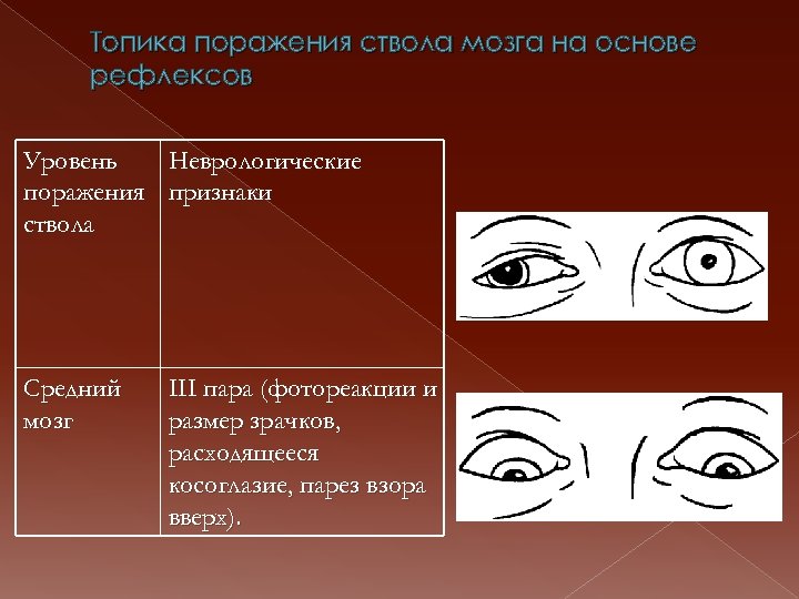 Топика поражения ствола мозга на основе рефлексов Уровень Неврологические поражения признаки ствола Средний мозг