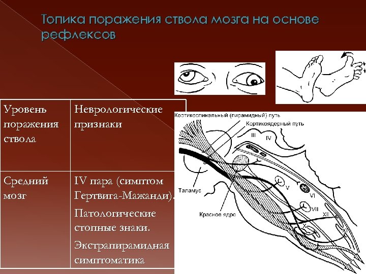 Топика поражения ствола мозга на основе рефлексов Уровень поражения ствола Неврологические признаки Средний мозг