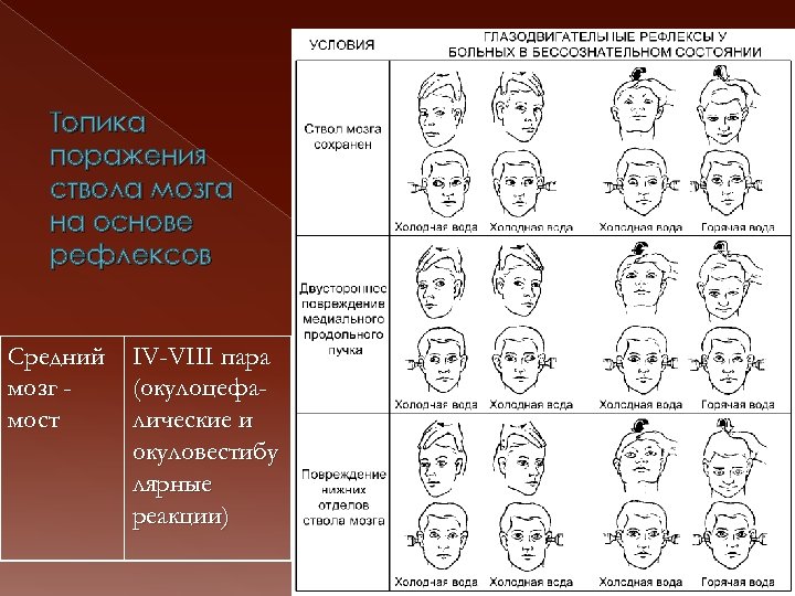 Топика поражения ствола мозга на основе рефлексов Средний IV-VIII пара мозг (окулоцефамост лические и