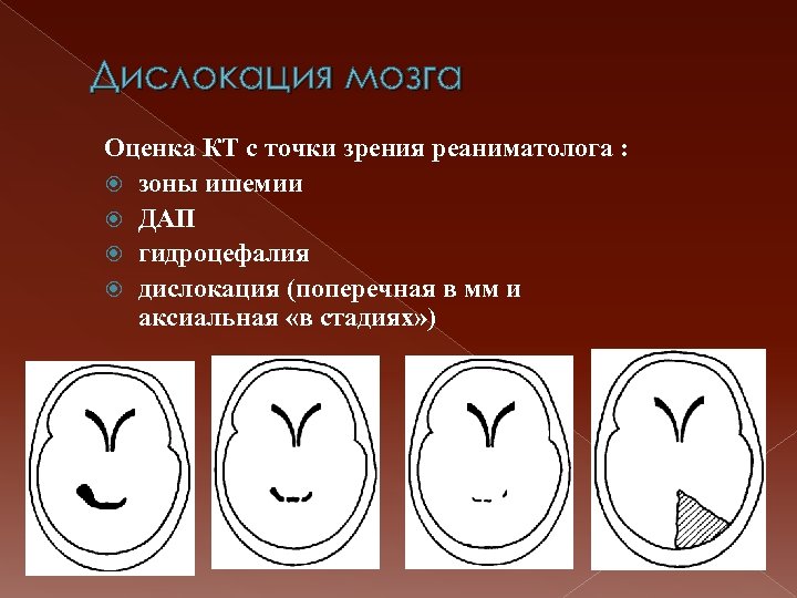 Точка дислокации. Аксиальная дислокация мозга. Дислокация ствола мозга.