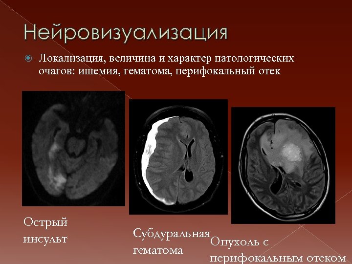 Нейровизуализация Локализация, величина и характер патологических очагов: ишемия, гематома, перифокальный отек Острый инсульт Субдуральная