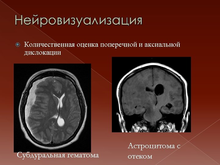 Нейровизуализация Количественная оценка поперечной и аксиальной дислокации Субдуральная гематома Астроцитома с отеком 