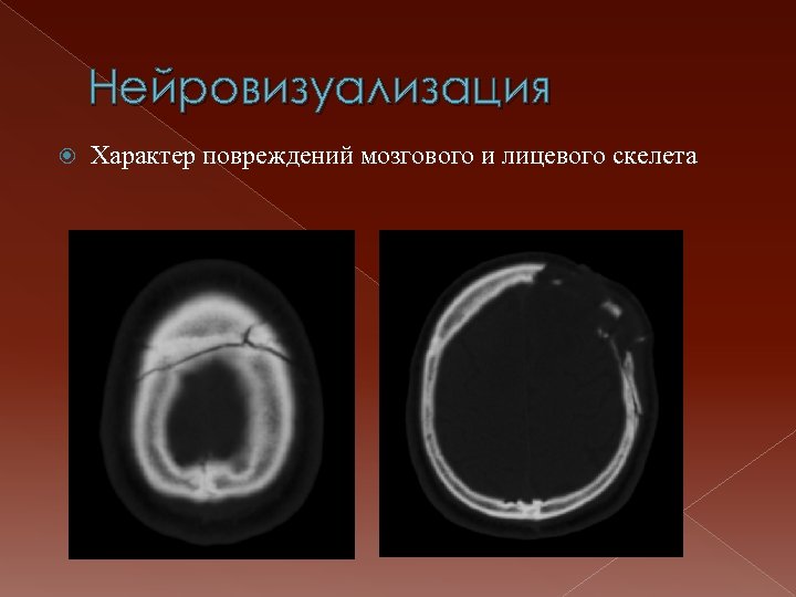 Нейровизуализация Характер повреждений мозгового и лицевого скелета 