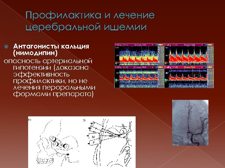 Профилактика и лечение церебральной ишемии Антагонисты кальция (нимодипин) опасность артериальной гипотензии (доказана эффективность профилактики,