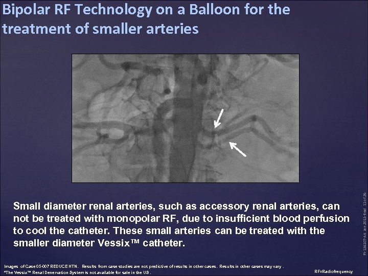 Small diameter renal arteries, such as accessory renal arteries, can not be treated with