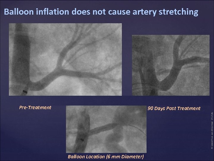 Balloon inflation does not cause artery stretching Pre-Treatment PI-136107 -AA Jan 2013 -final 17