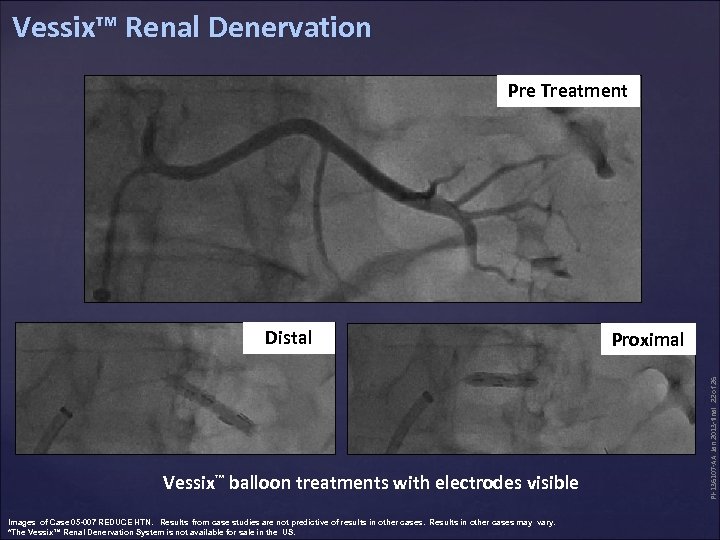Vessix™ Renal Denervation Pre Treatment Vessix™ balloon treatments with electrodes visible Images of Case