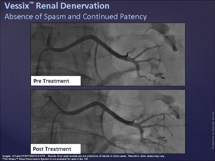 Vessix™ Renal Denervation Absence of Spasm and Continued Patency Post Treatment Images of Case