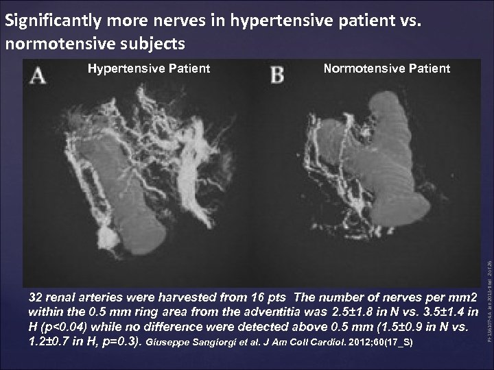 Significantly more nerves in hypertensive patient vs. normotensive subjects Normotensive Patient 32 renal arteries
