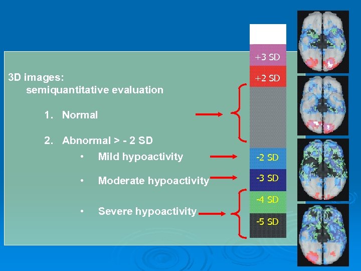 +4 SD +3 SD 3 D images: semiquantitative evaluation +2 SD 1. Normal 2.
