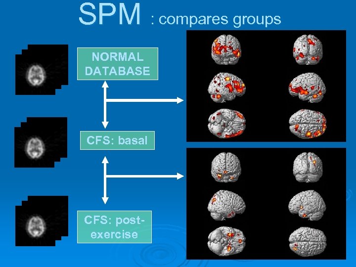 SPM : compares groups NORMAL DATABASE CFS: basal CFS: postexercise 
