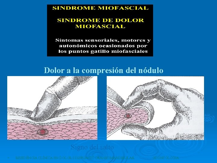 Dolor a la compresión del nódulo Signo del salto • RESIDÈNCIA CLÍNICA EN DOLOR