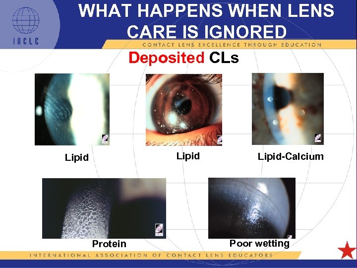 WHAT HAPPENS WHEN LENS CARE IS IGNORED Deposited CLs Lipid-Calcium Poor wetting Protein 5
