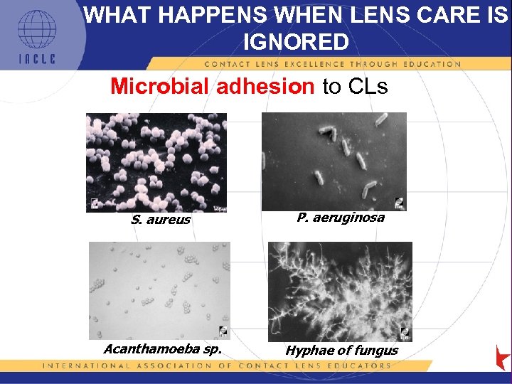 WHAT HAPPENS WHEN LENS CARE IS IGNORED Microbial adhesion to CLs S. aureus P.