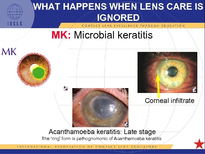 WHAT HAPPENS WHEN LENS CARE IS IGNORED MK: Microbial keratitis Corneal infiltrate Acanthamoeba keratitis: