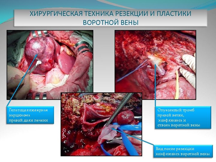 ХИРУРГИЧЕСКАЯ ТЕХНИКА РЕЗЕКЦИИ И ПЛАСТИКИ ВОРОТНОЙ ВЕНЫ Гепатоцеллюлярная карцинома правой доли печени Опухолевый тромб