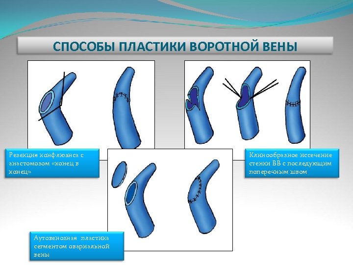 СПОСОБЫ ПЛАСТИКИ ВОРОТНОЙ ВЕНЫ Резекция конфлюэнса с анастомозом «конец в конец» Аутовенозная пластика сегментом