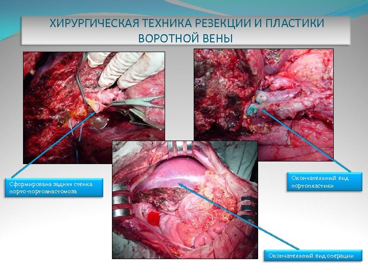 ХИРУРГИЧЕСКАЯ ТЕХНИКА РЕЗЕКЦИИ И ПЛАСТИКИ ВОРОТНОЙ ВЕНЫ Сформирована задняя стенка порто-портоанастомоза Окончательный вид портопластики