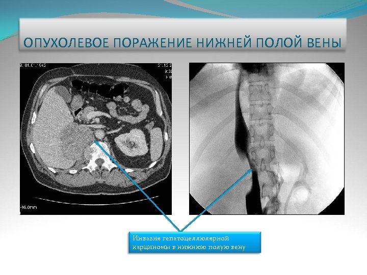 ОПУХОЛЕВОЕ ПОРАЖЕНИЕ НИЖНЕЙ ПОЛОЙ ВЕНЫ Инвазия гепатоцеллюлярной карциномы в нижнюю полую вену 