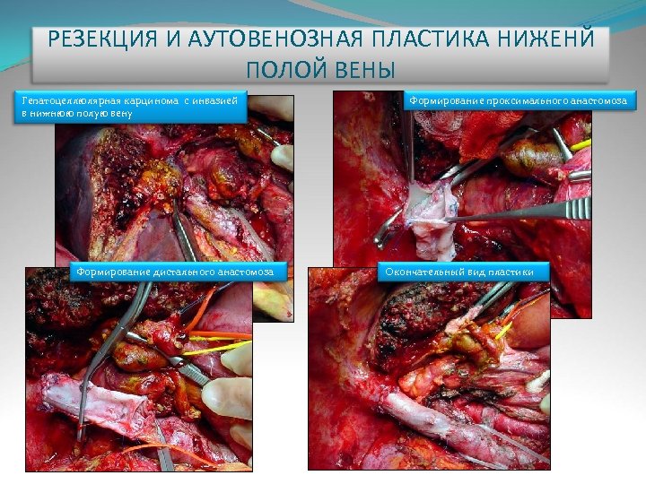 РЕЗЕКЦИЯ И АУТОВЕНОЗНАЯ ПЛАСТИКА НИЖЕНЙ ПОЛОЙ ВЕНЫ Гепатоцеллюлярная карцинома с инвазией в нижнюю полую