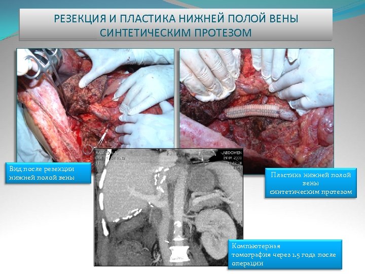 РЕЗЕКЦИЯ И ПЛАСТИКА НИЖНЕЙ ПОЛОЙ ВЕНЫ СИНТЕТИЧЕСКИМ ПРОТЕЗОМ Вид после резекции нижней полой вены