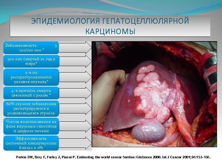 ЭПИДЕМИОЛОГИЯ ГЕПАТОЦЕЛЛЮЛЯРНОЙ КАРЦИНОМЫ Заболеваемость -120/100 000 * 5 500 000 смертей за год в