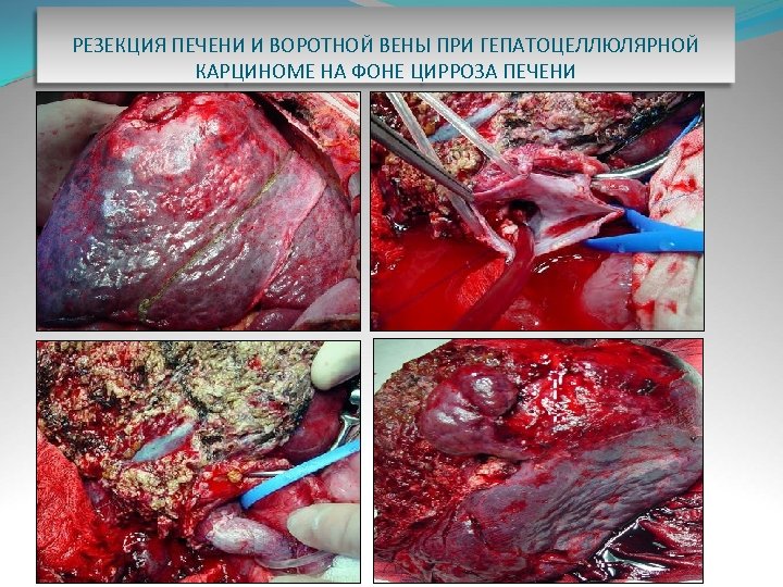 РЕЗЕКЦИЯ ПЕЧЕНИ И ВОРОТНОЙ ВЕНЫ ПРИ ГЕПАТОЦЕЛЛЮЛЯРНОЙ КАРЦИНОМЕ НА ФОНЕ ЦИРРОЗА ПЕЧЕНИ 