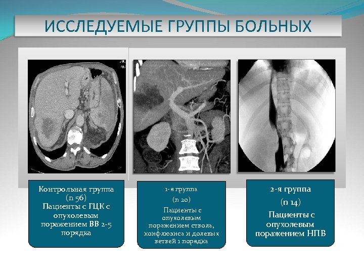 ИССЛЕДУЕМЫЕ ГРУППЫ БОЛЬНЫХ Контрольная группа (n 56) Пациенты с ГЦК с опухолевым поражением ВВ