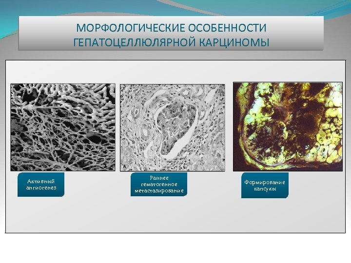 МОРФОЛОГИЧЕСКИЕ ОСОБЕННОСТИ ГЕПАТОЦЕЛЛЮЛЯРНОЙ КАРЦИНОМЫ Активный ангиогенез Раннее гематогенное метастазирование Формирование капсулы 