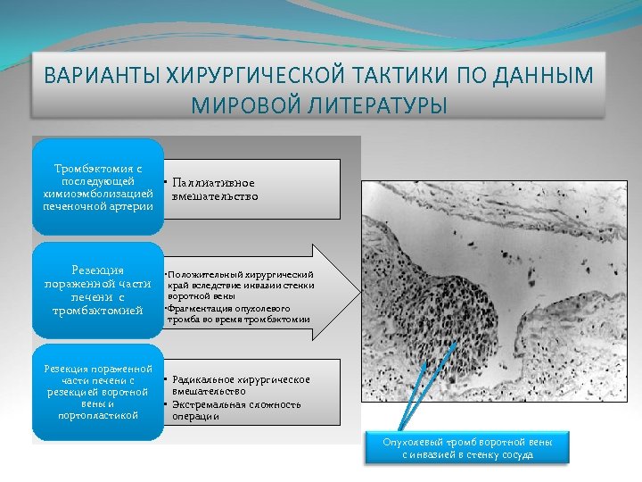 ВАРИАНТЫ ХИРУРГИЧЕСКОЙ ТАКТИКИ ПО ДАННЫМ МИРОВОЙ ЛИТЕРАТУРЫ Тромбэктомия с последующей • Паллиативное химиоэмболизацией вмешательство