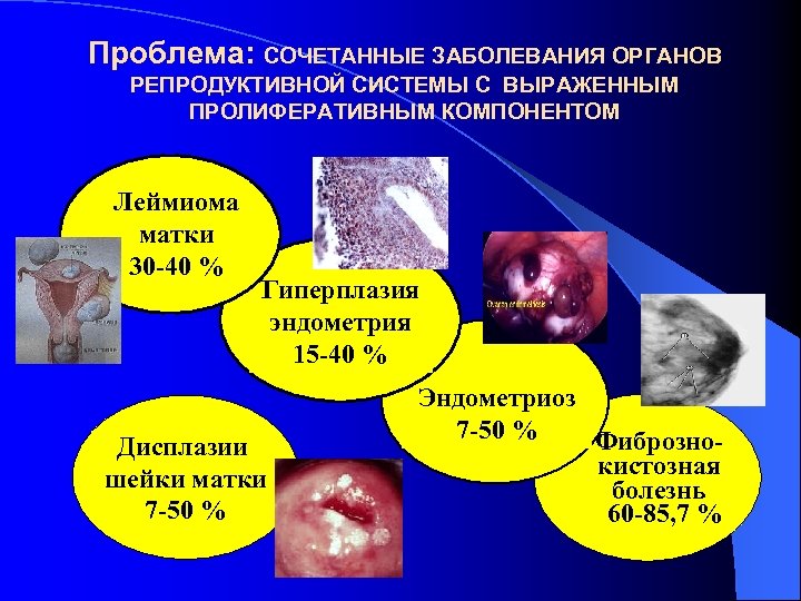 Проблема: СОЧЕТАННЫЕ ЗАБОЛЕВАНИЯ ОРГАНОВ РЕПРОДУКТИВНОЙ СИСТЕМЫ С ВЫРАЖЕННЫМ ПРОЛИФЕРАТИВНЫМ КОМПОНЕНТОМ Леймиома матки 30 -40