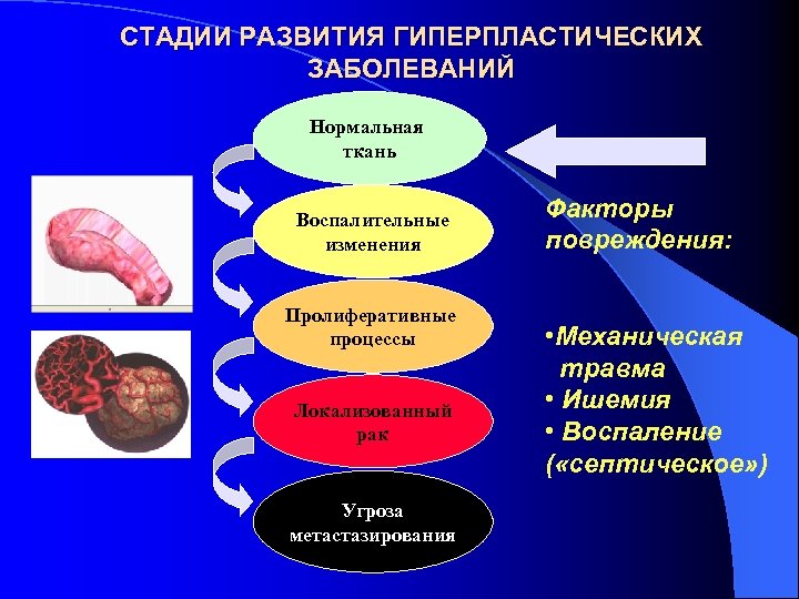 СТАДИИ РАЗВИТИЯ ГИПЕРПЛАСТИЧЕСКИХ ЗАБОЛЕВАНИЙ Нормальная ткань Воспалительные изменения Пролиферативные процессы Локализованный рак Угроза метастазирования