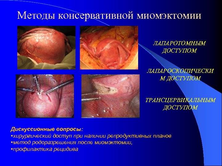 Методы консервативной миомэктомии ЛАПАРОТОМНЫМ ДОСТУПОМ ЛАПАРОСКОПИЧЕСКИ М ДОСТУПОМ ТРАНСЦЕРВИКАЛЬНЫМ ДОСТУПОМ Дискуссионные вопросы: • хирургический