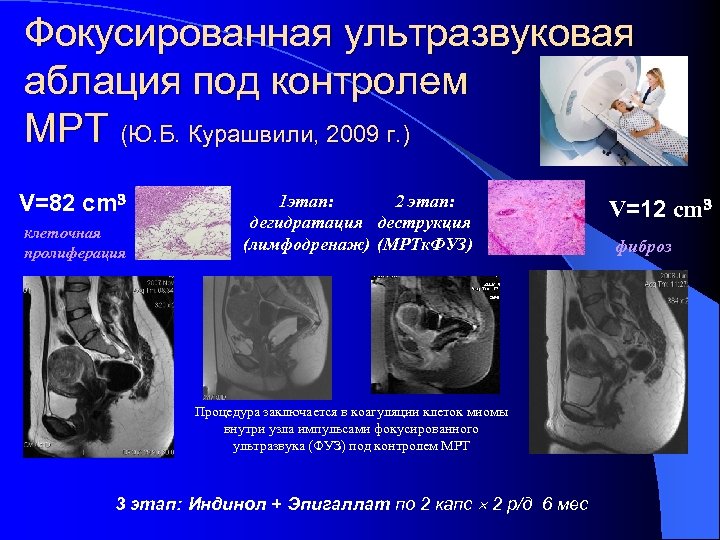 Фокусированная ультразвуковая аблация под контролем МРТ (Ю. Б. Курашвили, 2009 г. ) V=82 cm³
