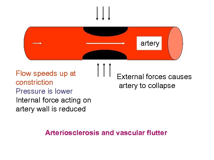 artery Flow speeds up at constriction Pressure is lower Internal force acting on artery