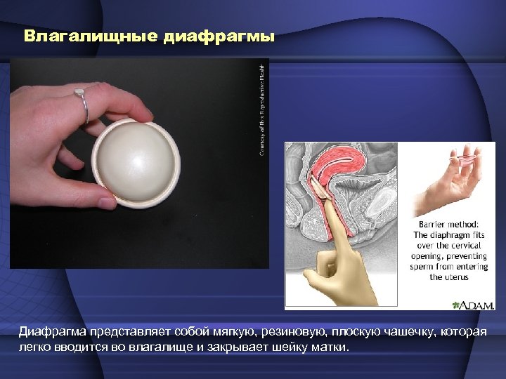 Влагалищные диафрагмы Диафрагма представляет собой мягкую, резиновую, плоскую чашечку, которая легко вводится во влагалище