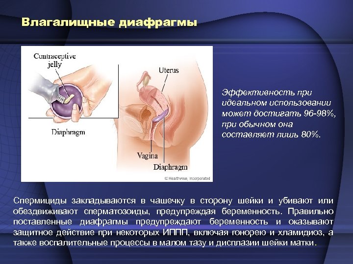 Влагалищные диафрагмы Эффективность при идеальном использовании может достигать 96 -98%, при обычном она составляет