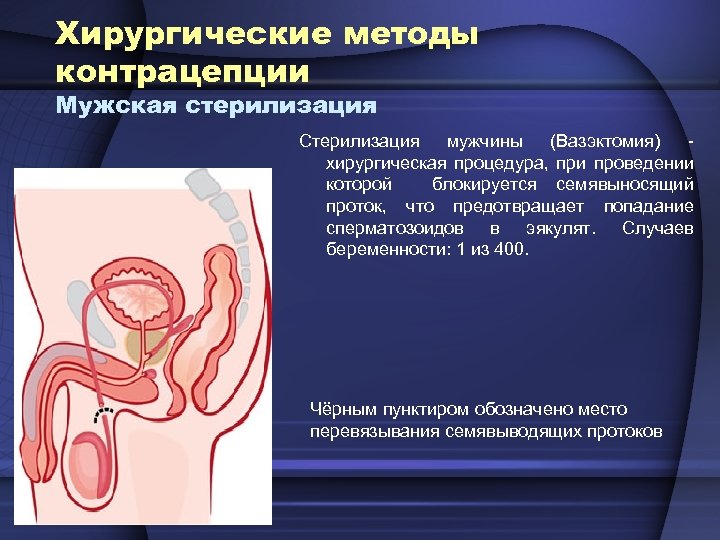 Хирургические методы контрацепции Мужская стерилизация Стерилизация мужчины (Вазэктомия) - хирургическая процедура, при проведении которой