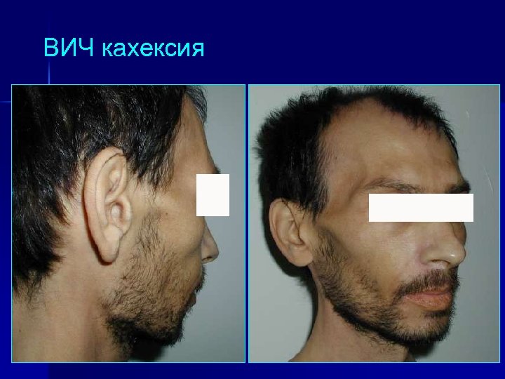 ВИЧ кахексия 