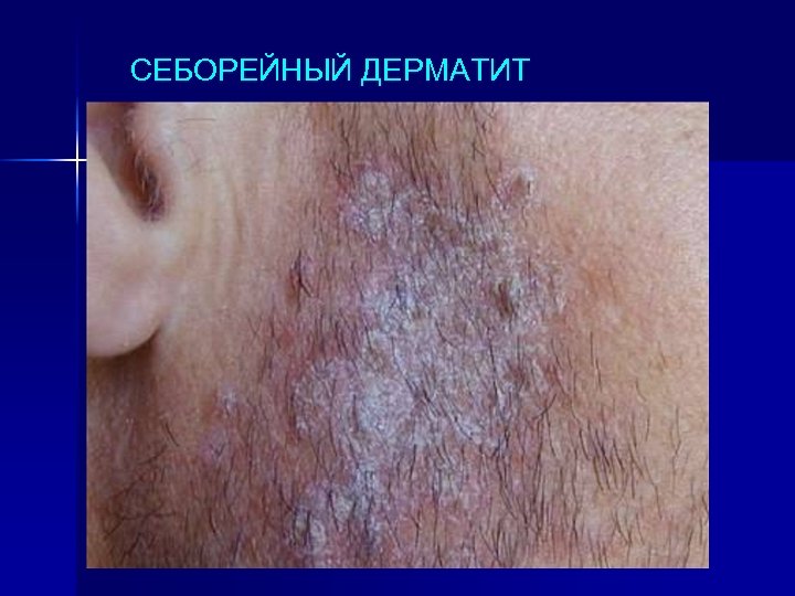 СЕБОРЕЙНЫЙ ДЕРМАТИТ 