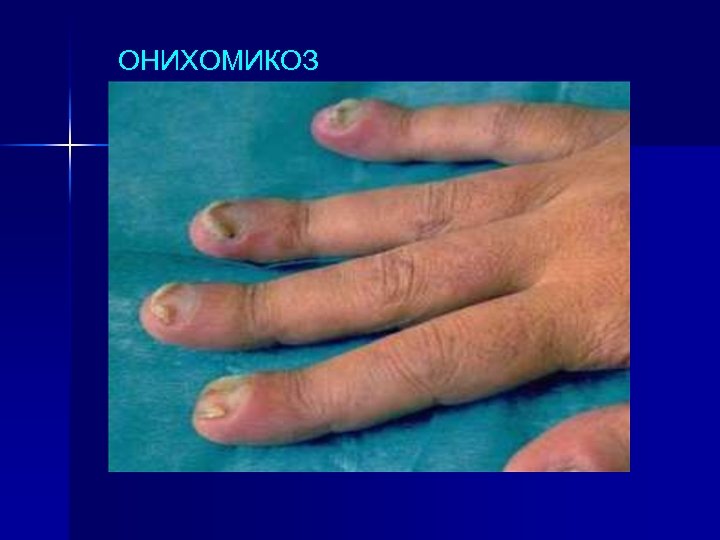 ОНИХОМИКОЗ 