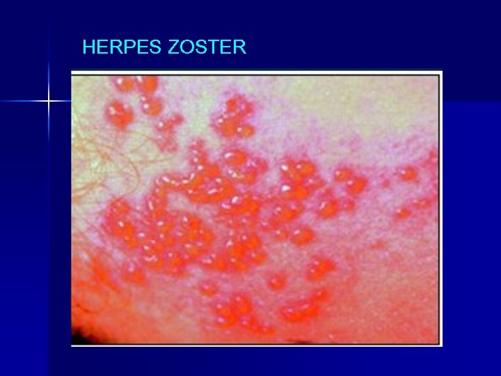 HERPES ZOSTER 