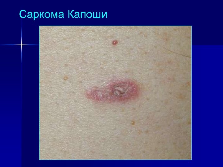 Саркома Капоши 