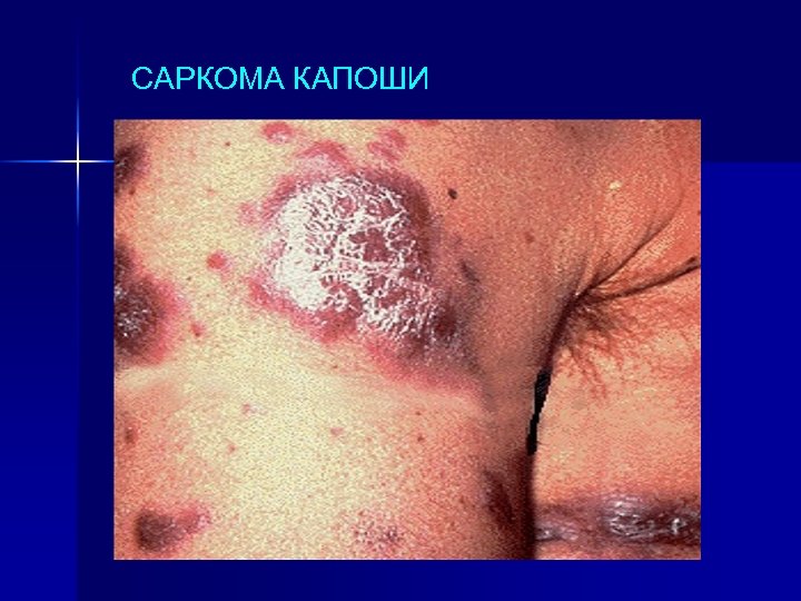 САРКОМА КАПОШИ 
